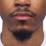 Facial Hair Beard Before and After | Dr. Jeffrey Wise