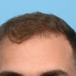 Fue Before and After | Dr. Jeffrey Wise