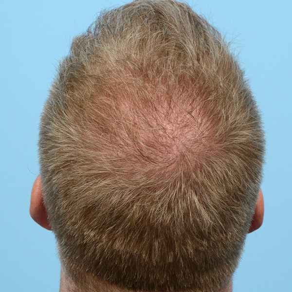 Fue Before and After | Dr. Jeffrey Wise