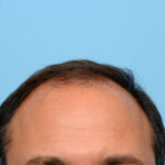 Fue Before and After | Dr. Jeffrey Wise
