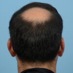 Fue Before and After | Dr. Jeffrey Wise