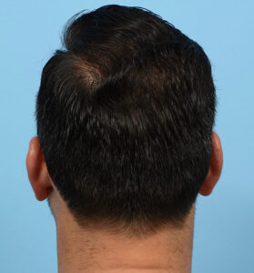 Fue Before and After | Dr. Jeffrey Wise