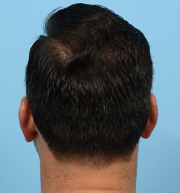 Fue Before and After | Dr. Jeffrey Wise