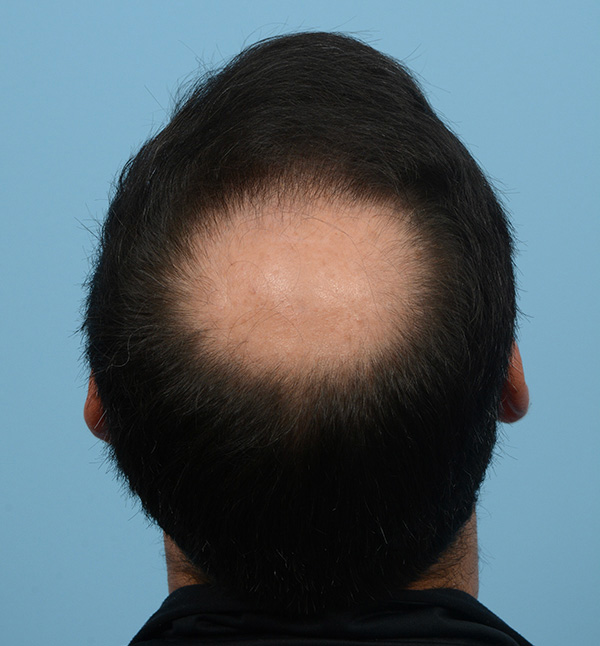 Fue Before and After | Dr. Jeffrey Wise