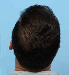 Fue Before and After | Dr. Jeffrey Wise
