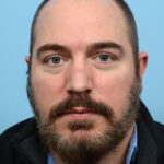 Fue Before and After | Dr. Jeffrey Wise