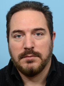 Fue Before and After | Dr. Jeffrey Wise