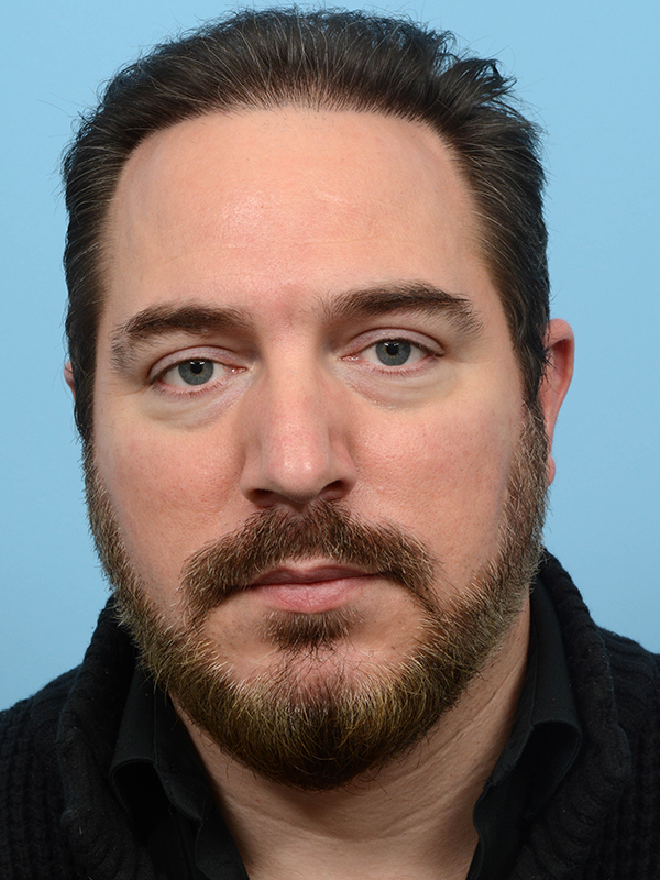 Fue Before and After | Dr. Jeffrey Wise