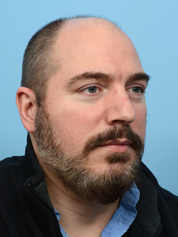 Fue Before and After | Dr. Jeffrey Wise