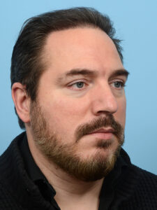 Fue Before and After | Dr. Jeffrey Wise