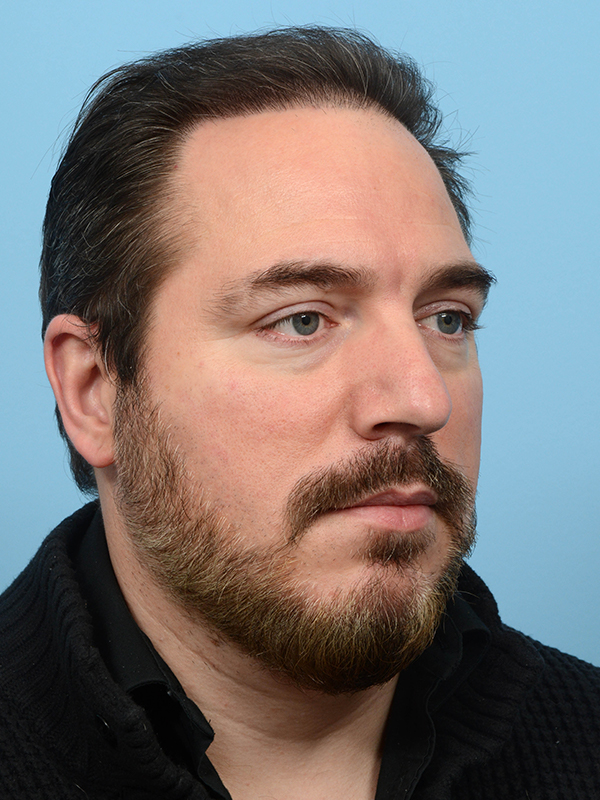 Fue Before and After | Dr. Jeffrey Wise