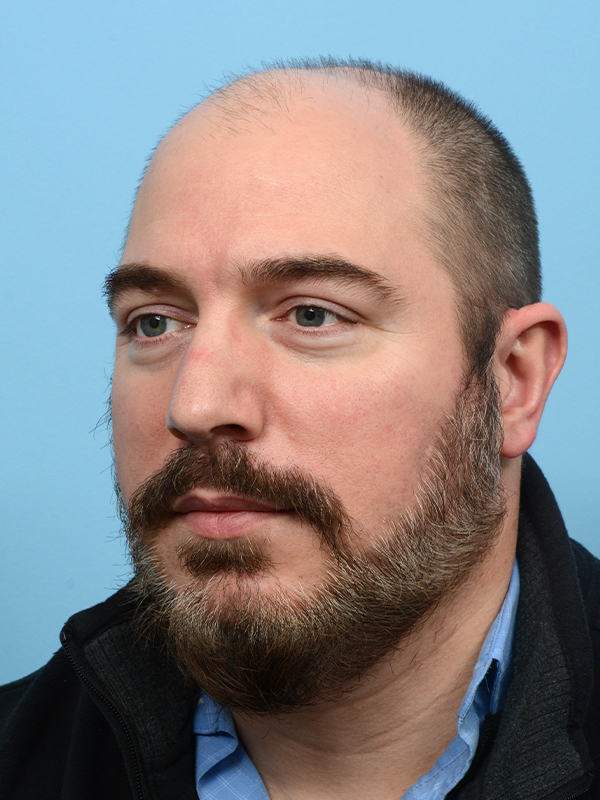 Fue Before and After | Dr. Jeffrey Wise