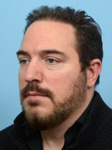 Fue Before and After | Dr. Jeffrey Wise