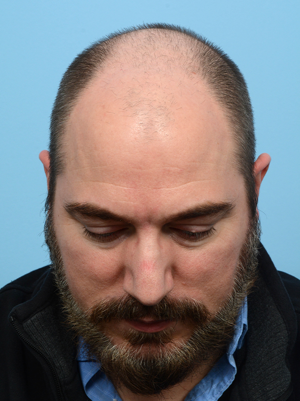 Fue Before and After | Dr. Jeffrey Wise