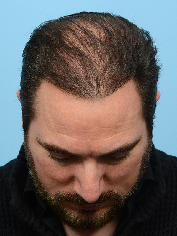 Fue Before and After | Dr. Jeffrey Wise