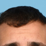 Fue Before and After | Dr. Jeffrey Wise