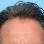 Fue Before and After | Dr. Jeffrey Wise