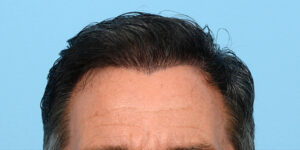 Fue Before and After | Dr. Jeffrey Wise