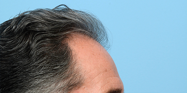 Fue Before and After | Dr. Jeffrey Wise
