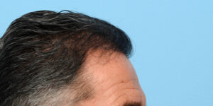 Fue Before and After | Dr. Jeffrey Wise