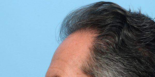 Fue Before and After | Dr. Jeffrey Wise