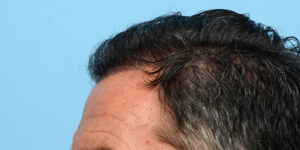 Fue Before and After | Dr. Jeffrey Wise