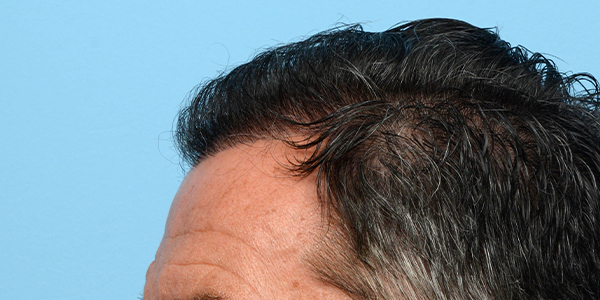 Fue Before and After | Dr. Jeffrey Wise