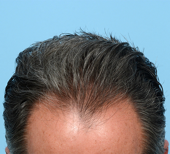 Fue Before and After | Dr. Jeffrey Wise