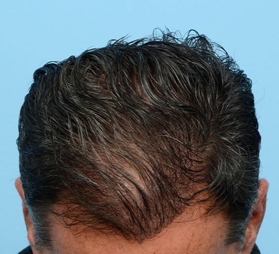Fue Before and After | Dr. Jeffrey Wise