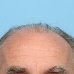 Fue Before and After | Dr. Jeffrey Wise