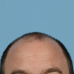 Fue Before and After | Dr. Jeffrey Wise