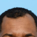 Fue Before and After | Dr. Jeffrey Wise
