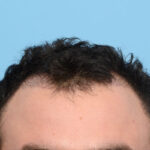 Fue Before and After | Dr. Jeffrey Wise