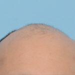 Fue Before and After | Dr. Jeffrey Wise
