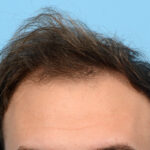 Fue Before and After | Dr. Jeffrey Wise