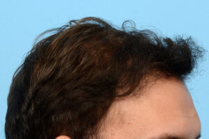 Fue Before and After | Dr. Jeffrey Wise
