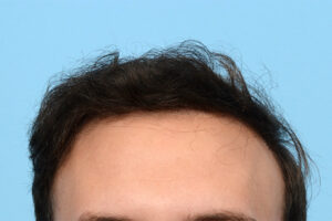 Fue Before and After | Dr. Jeffrey Wise
