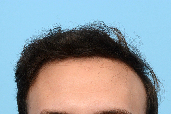 Fue Before and After | Dr. Jeffrey Wise