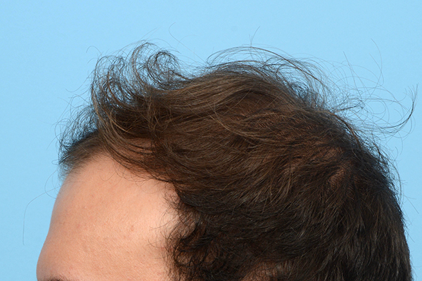 Fue Before and After | Dr. Jeffrey Wise