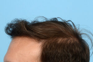 Fue Before and After | Dr. Jeffrey Wise