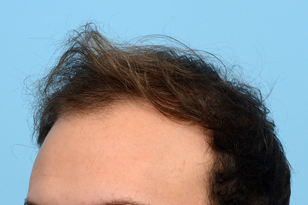 Fue Before and After | Dr. Jeffrey Wise