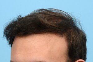 Fue Before and After | Dr. Jeffrey Wise