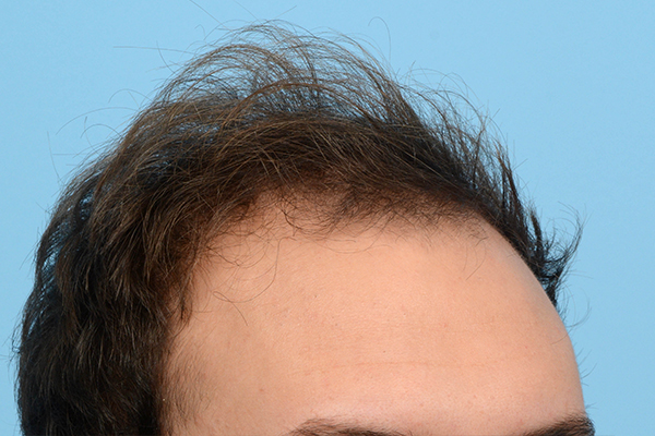 Fue Before and After | Dr. Jeffrey Wise