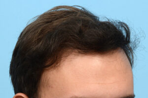 Fue Before and After | Dr. Jeffrey Wise