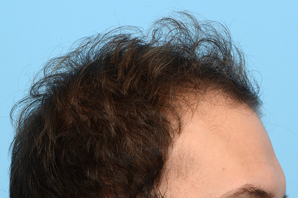 Fue Before and After | Dr. Jeffrey Wise
