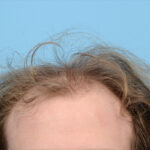 Fue Before and After | Dr. Jeffrey Wise