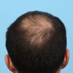 Fue Before and After | Dr. Jeffrey Wise