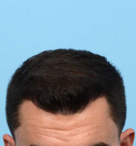 Fue Before and After | Dr. Jeffrey Wise
