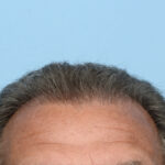 Fue Before and After | Dr. Jeffrey Wise
