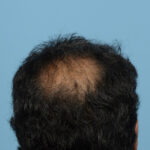 Fue Before and After | Dr. Jeffrey Wise